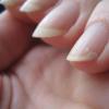 Почему отпадают ногти: лечение и причины